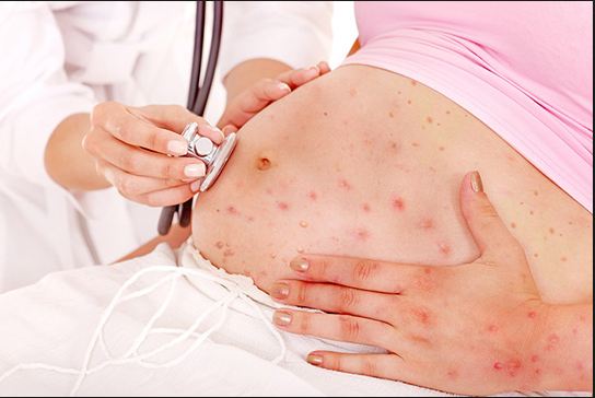 Phụ nữ mắc dịch sởi trong qu&aacute; tr&igrave;nh mang thai