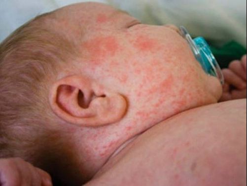 H&igrave;nh ảnh trẻ nhỏ bị sởi