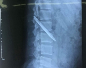 Chiến sĩ công an cùng lưỡi dao dài 13 cm nằm trong cơ thể 11 năm